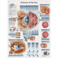 3B Scientific® Anatomical Charts; Diseases Of The Eye